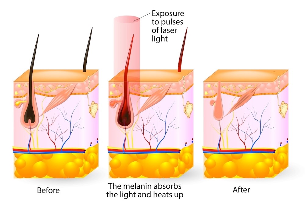 The follicle absorbs the light and heat resulting in permanent damage. Which means no more hair!