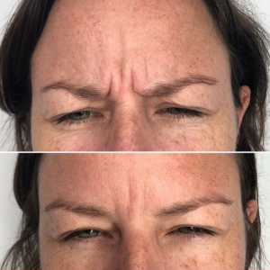 anti ageing wrinkle before after