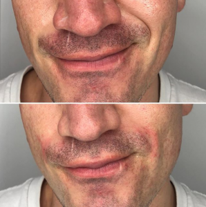 smile lines before and after